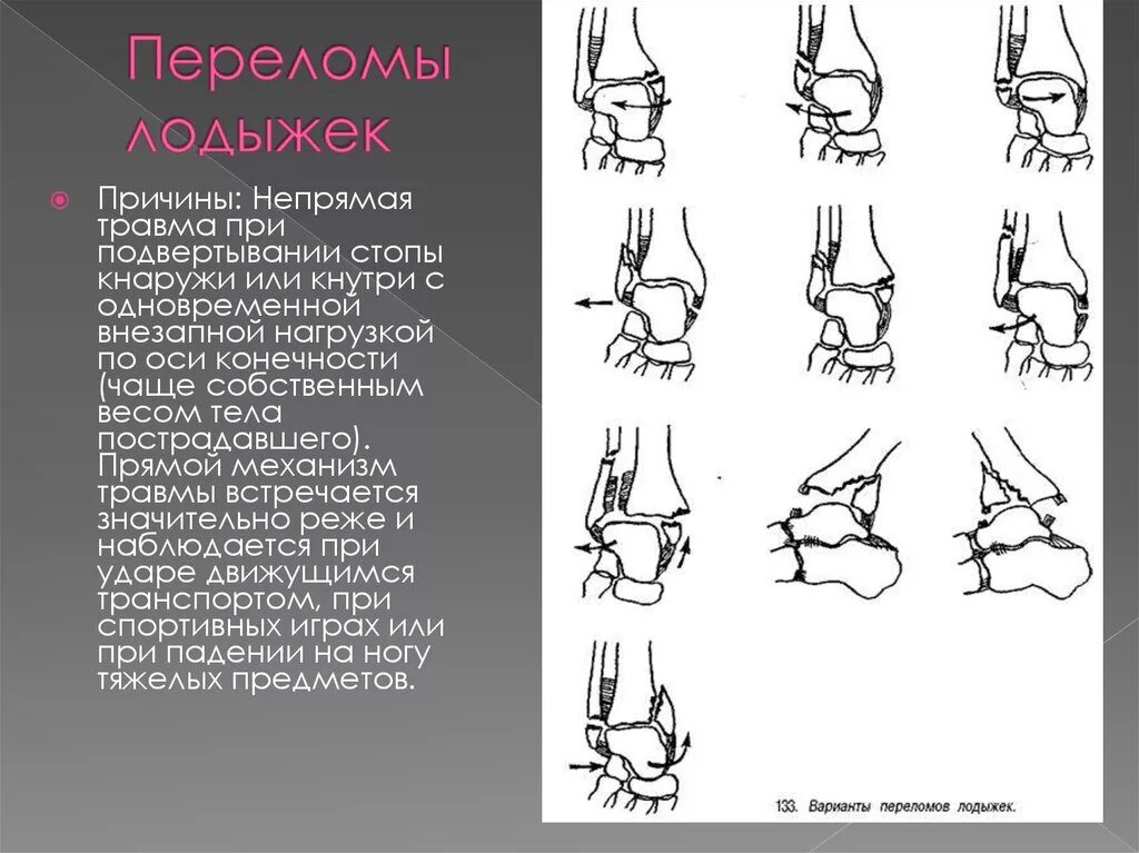 Сколько времени болят переломы. Повреждение голеностопного сустава механизм травмы. Остеосинтез лодыжки реабилитация. Остеосинтез двухлодыжечный перелом.