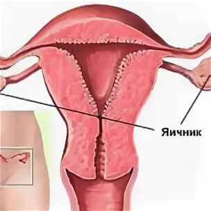 Как лечить дисфункцию яичников