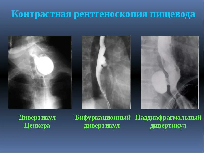 С г пищевода