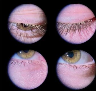 Blepharitis латынь