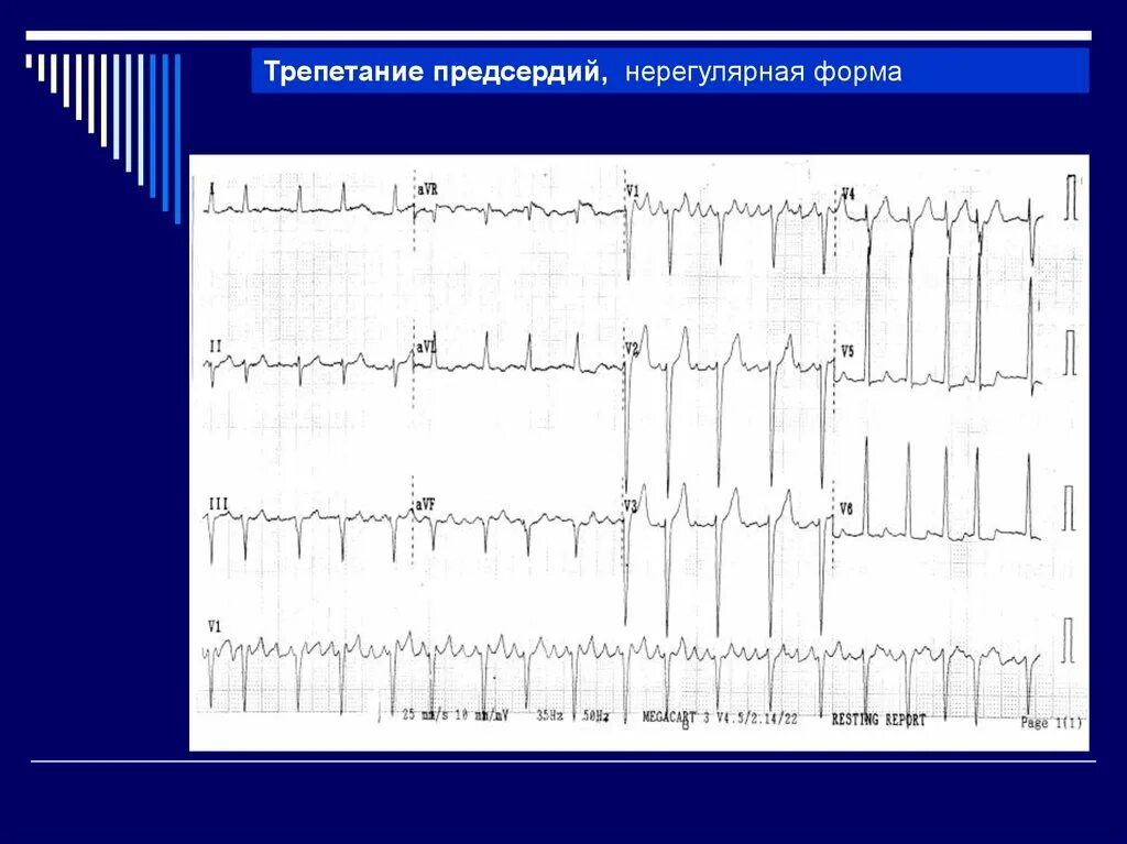 Трепетание предсердий 2:1. Трепетание предсердий нерегулярная форма. Трепетание предсердий неправильная форма. Формы трепетания предсердий