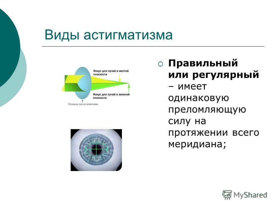 Прогрессирующий астигматизм. Прогрессирующий астигматизм