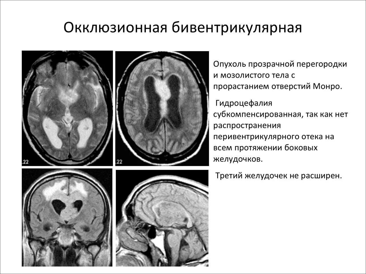 Выражено умеренно гидроцефалия мозга. Внутренняя окклюзионная гидроцефалия мрт. Наружная гидроцефалия головного мозга кт. Наружная внутренняя гидроцефалия мрт. Наружная гидроцефалия на кт.