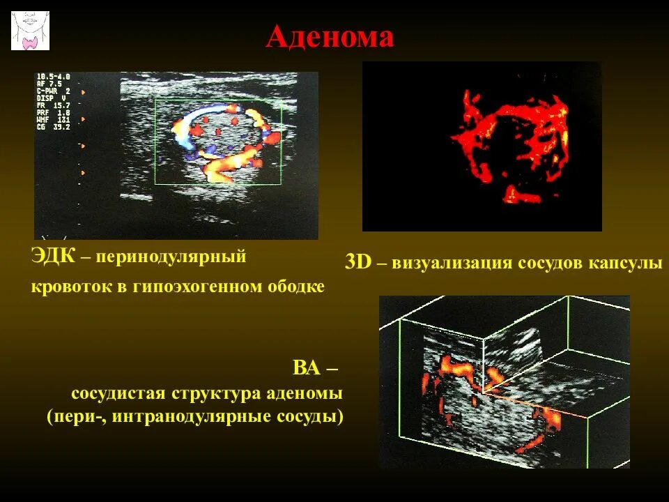 Перинодулярный кровоток что это. Energeticheskoe doplerivskoe kartirovanie. Энергетическое допплеровское картирование. Что такое перемодулярный кровоток. Сосуды визуализация.