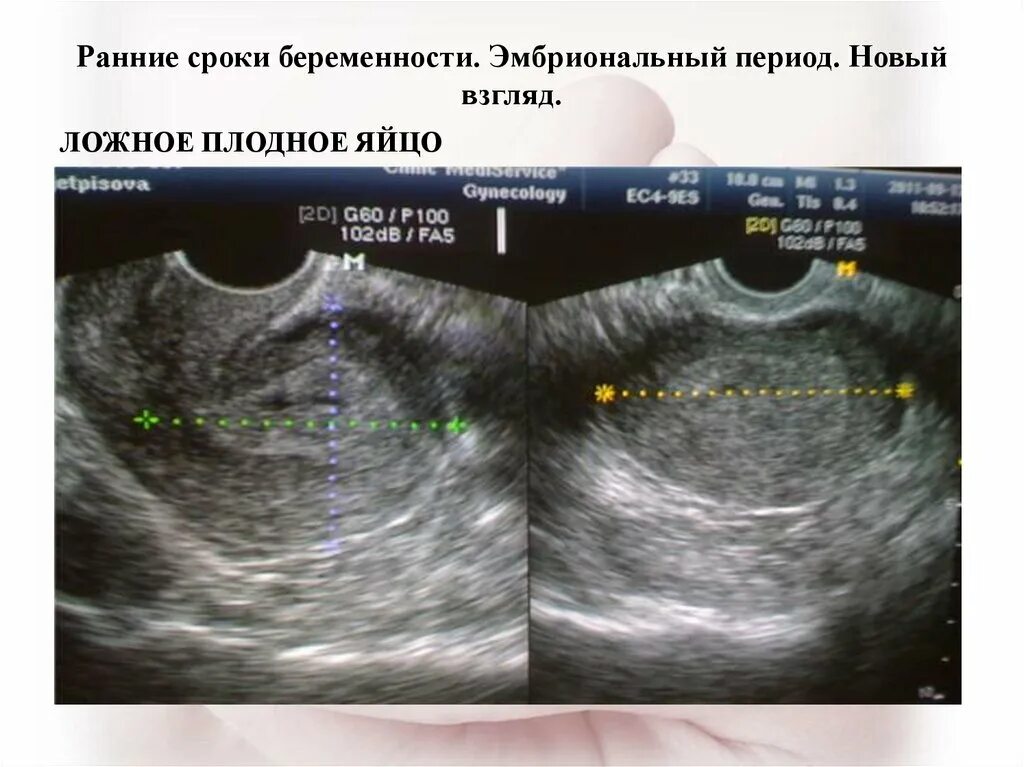 УЗИ матки измерения размеров. УЗИ по беременности на ранних сроках. УЗИ измерение размеров матки по УЗИ.