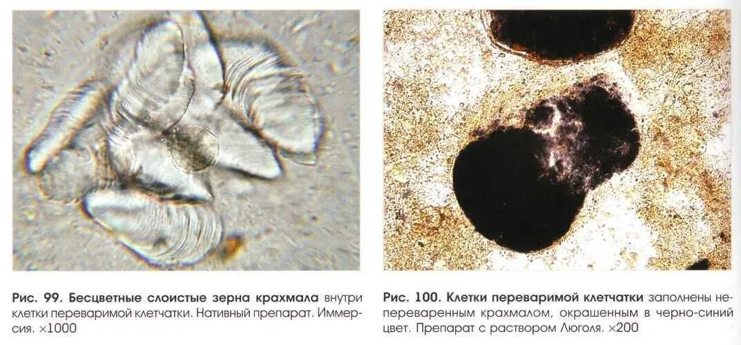 Перевариваемая растительная клетчатка в кале у ребенка. Микроскопия кала крахмал. Микроскопия кала растительная клетчатка непереваримая. Зерна крахмала в Кале под микроскопом. Копрология кала микроскопия.