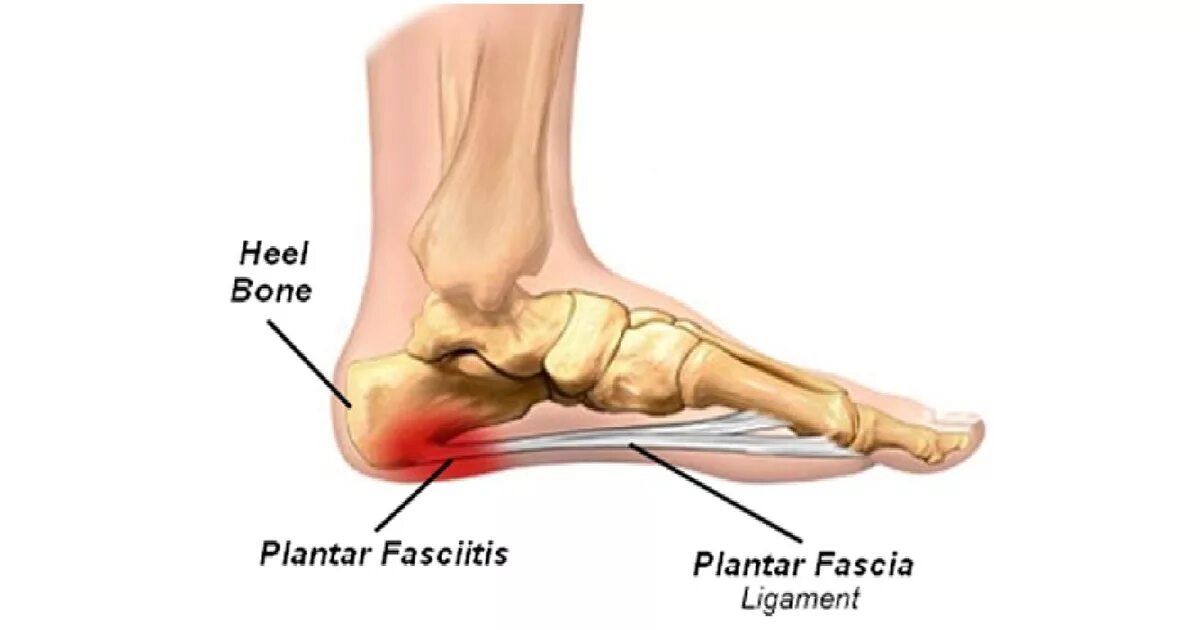 Get by foot. Фасциит подошвенного апоневроза. Плантарный фасциит стопы. Пяточная шпора плантарный фасциит.