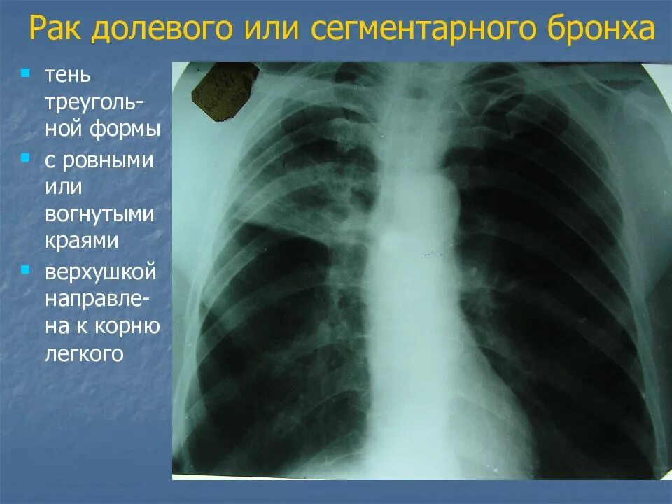 Стадии рака бронха. Злокачественное новообразование главного бронха. Опухоли бронхов и легких. Бронхогенная карцинома.