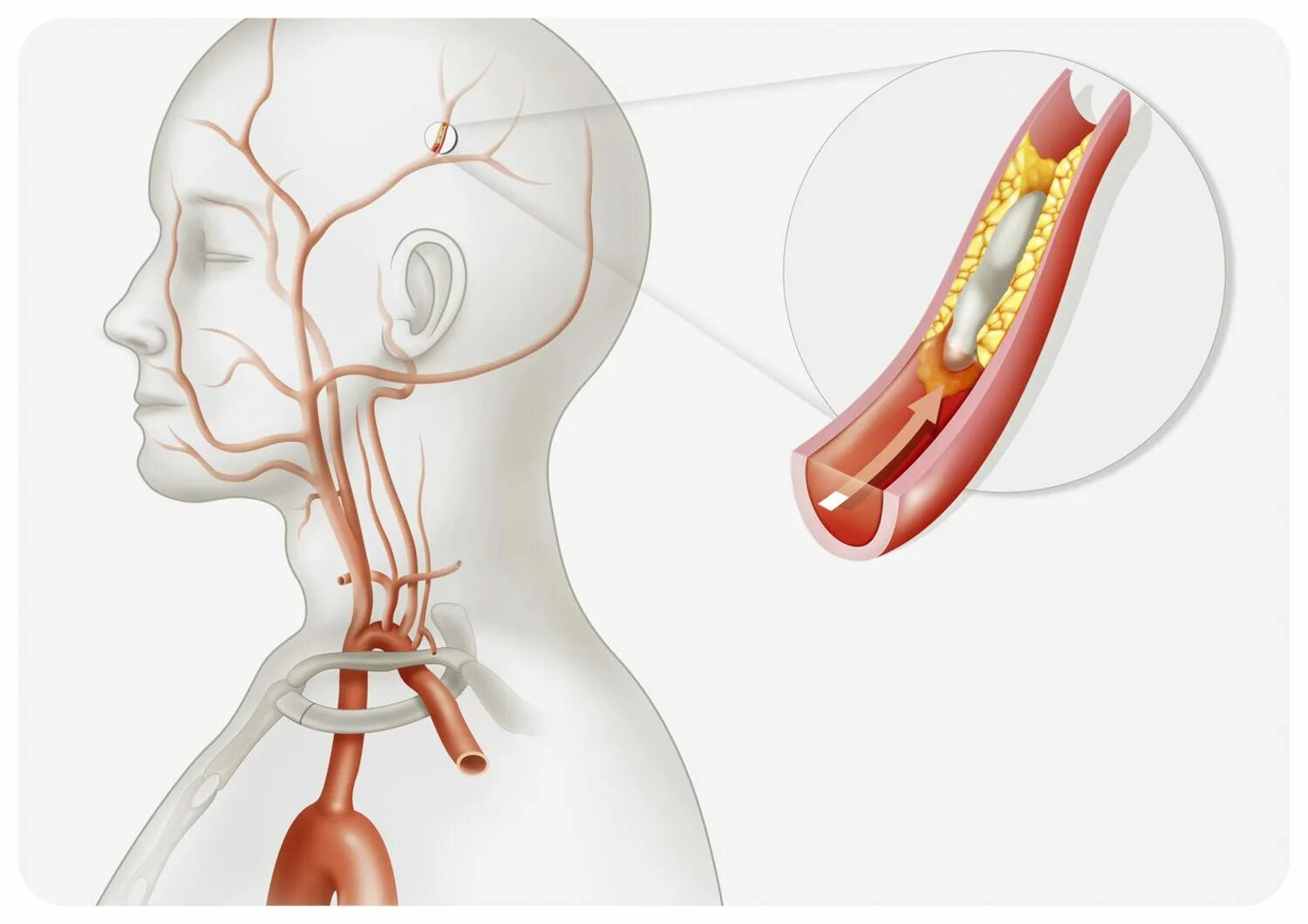 Бляшка в головном мозге. Брахиоцефальная артерия атеросклероз. Стеноз сосудов головного мозга. Атеросклероз артерия брахиоцефальных артерий. Атеросклероз сосудов шеи сонных артерий.
