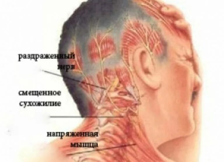 Онемевший затылок. Болит голова.