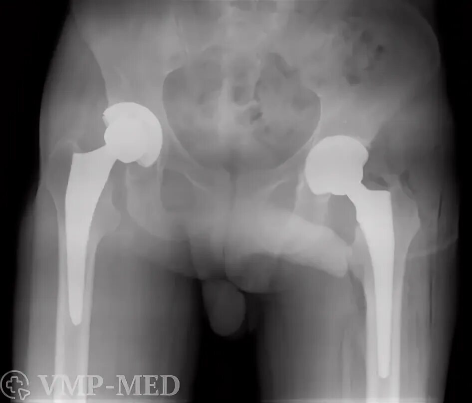 Эндопротезирование тазобедренного сустава рентген. Рентгенография тазобедренного сустава в 2-х проекциях. Тотальное эндопротезирование тазобедренного сустава рентген. Рентгенография бедренной кости в 2-х проекциях.