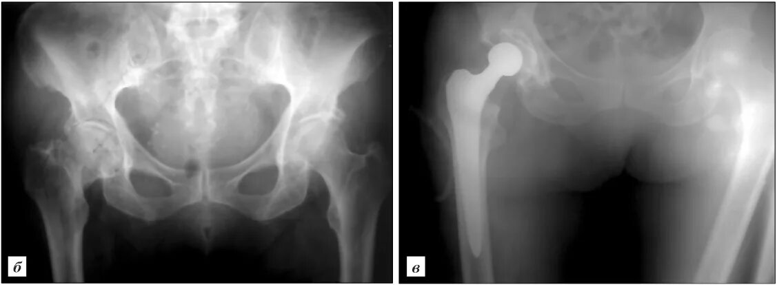 Перелом шейки бедра в пожилом возрасте. Псевдоартроз вертлужной впадины. Остеолизис шейки бедра. Перелом шейки бедра вертлужной впадины. Ложный сустав тазобедренного сустава.
