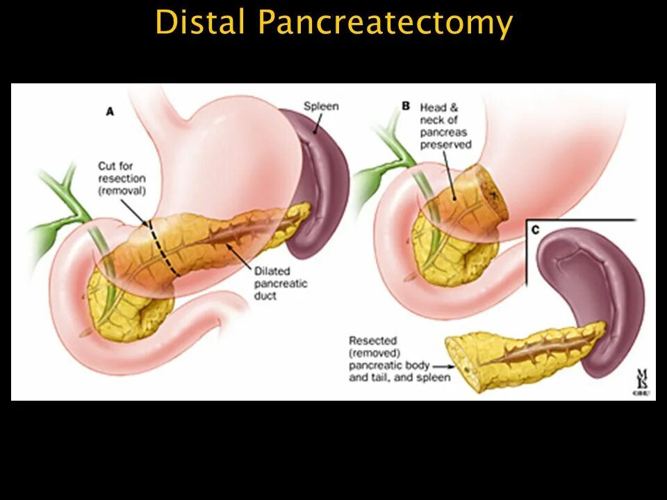 Поджелудочная железа панкреатит операция. Дистальная (левосторонняя) резекция поджелудочной железы. Корпокаудалтная резекция поджелудочной железы. Дистальная корпорокаудальная резекция поджелудочной железы. Дистальная резекция поджелудочной железы этапы операции.