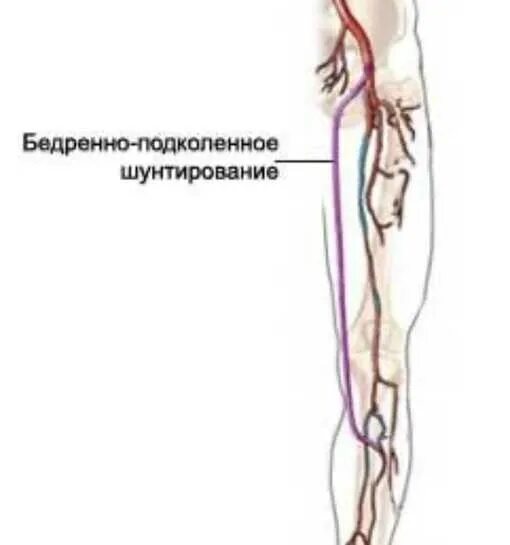 Операция бедренно подколенное шунтирование. Шунтирование бедренно подколенной артерии. Шунтирование реверсированной аутовеной бедренно-подколенное. Атеросклероз бедренной артерии.