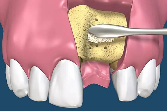 Костная пластика (остеопластика). Синус-лифтинг костная пластика. Синус-лифтинг (костная пластика, остеопластика). Костная пластика альвеолярного отростка. Пересадка кости