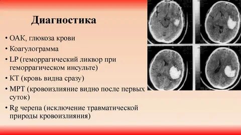 Онмк геморрагический