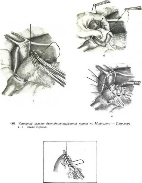 Антеградная аппендэктомия. Тиреоидэктомия операция. Энуклеация резекция щитовидной железы. Ориентиры резекции желудка. Торакоскопическая резекция легкого.