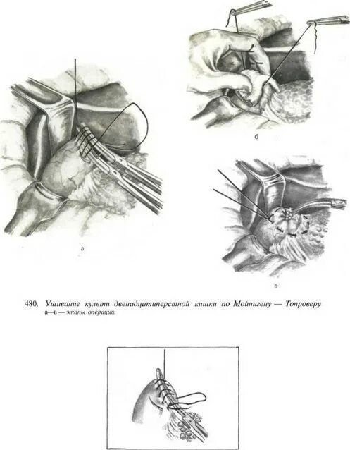 Ушивание разрывов. Ушивание язвы двенадцатиперстной кишки. Бильрот - 2 с гастроэнтероанастомозом. Ушивание культи двенадцатиперстной кишки. Резекция желудка по Бильрот 2 в модификации гофмейстера-Финстерера.
