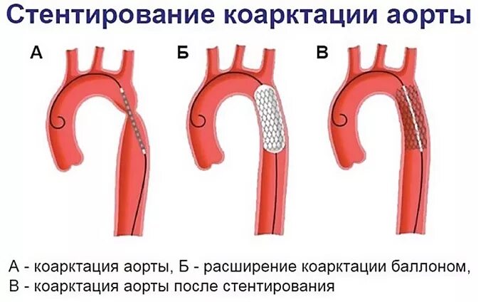 Протез восходящей аорты. Стент графт аневризма брюшной аорты. Аневризма грудной аорты протез. Операции при коарктации аорты. Стент графт грудной аорты.