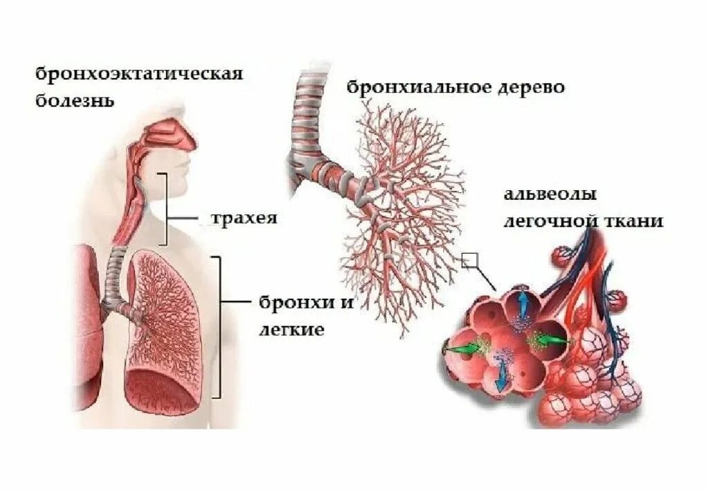 Бронхи при бронхоэктатической болезни. Бронхоэктатическая болезнь патология. Пневмония трахея бронхи. Бронхоэктатическая болезнь легких причины.