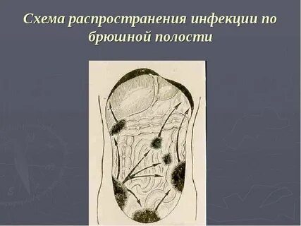 Инфекция в брюшной полости