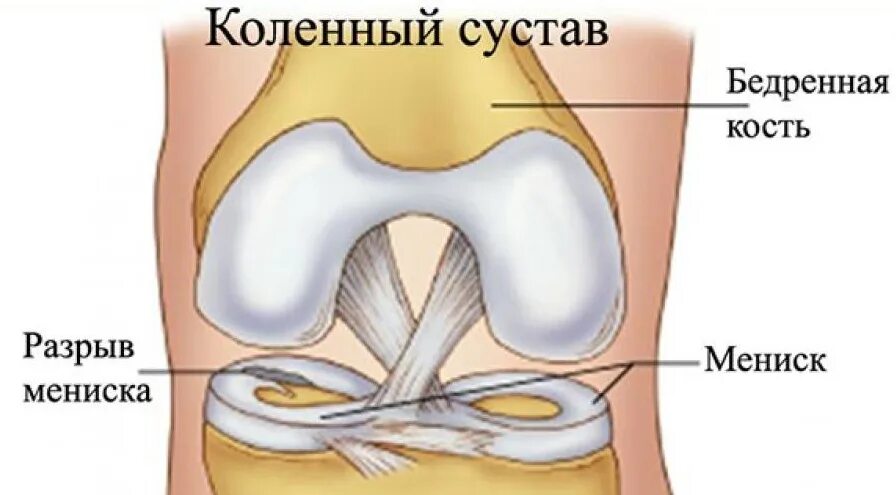 Менископатия коленного. Задний Рог медиального мениска анатомия. Разрыв мениска коленного сустава.