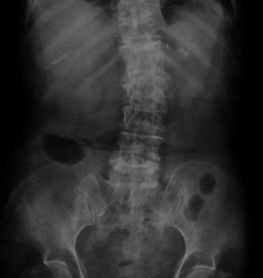Операции болезнь бехтерева. Болезнь бехтерева рентген позвоночника. Болезнь бехтерева на рентгенограмме. Болезнь бехтерева операция. Анкилозирующий спондилит крестцово подвздошного сочленения.