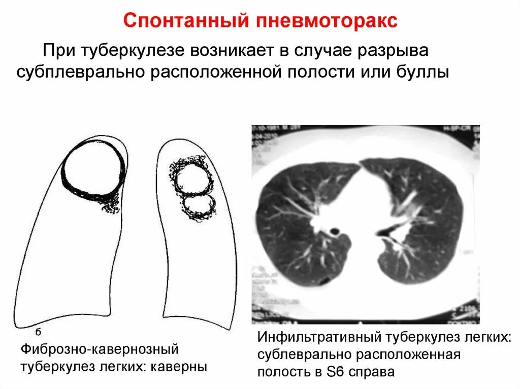 Спонтанный пневмоторакс туберкулез. Форма туберкулеза при спонтанном пневмотораксе. Спонтанный пневмоторакс при инфильтративном туберкулезе. Спонтанный пневмоторакс при туберкулезе.