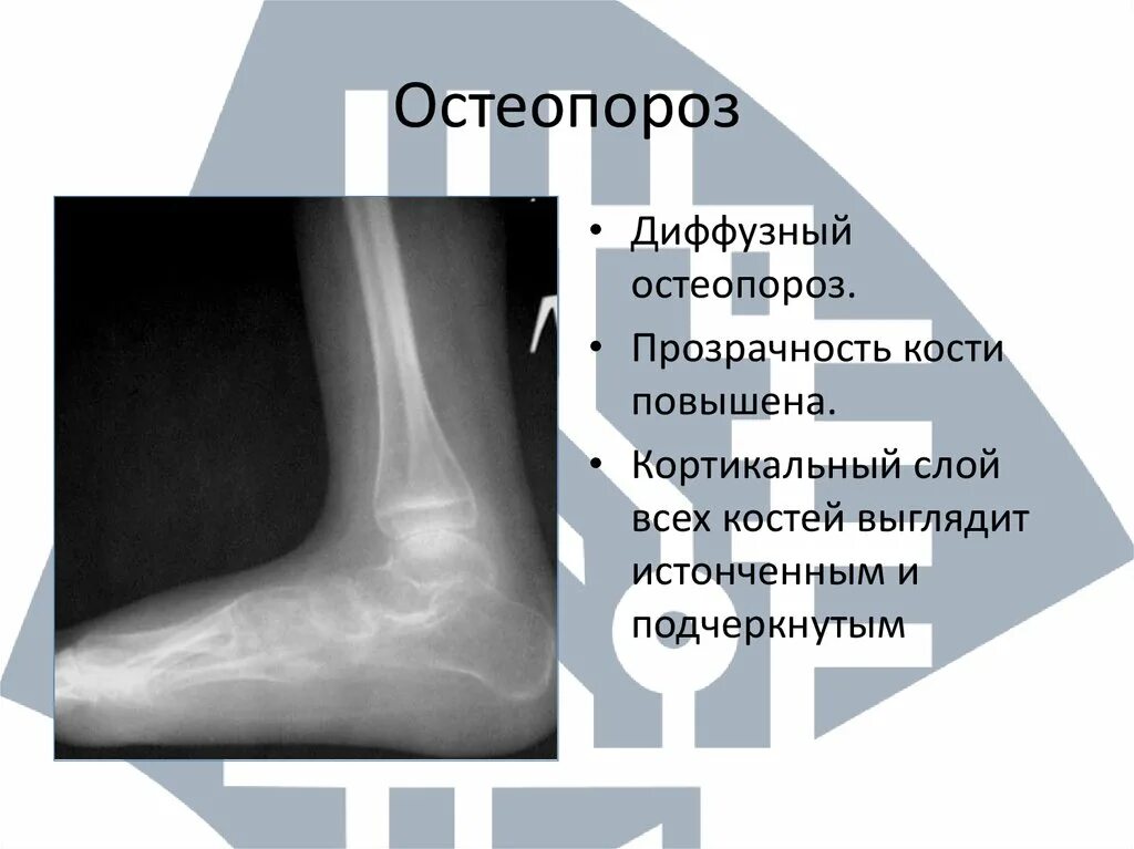 Диффузный остеопороз классификация. Диффузный остеопороз лечение. Диффузно-очаговый остеопороз. Клинические проявления остеопороза. Задачи лечения остеопороза.