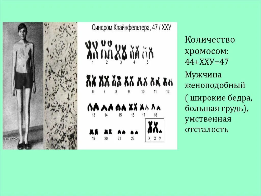 Сколько хромосом у мужчины. Синдром Клайнфельтера число хромосом. Синдром Клайнфельтера умственная отсталость.