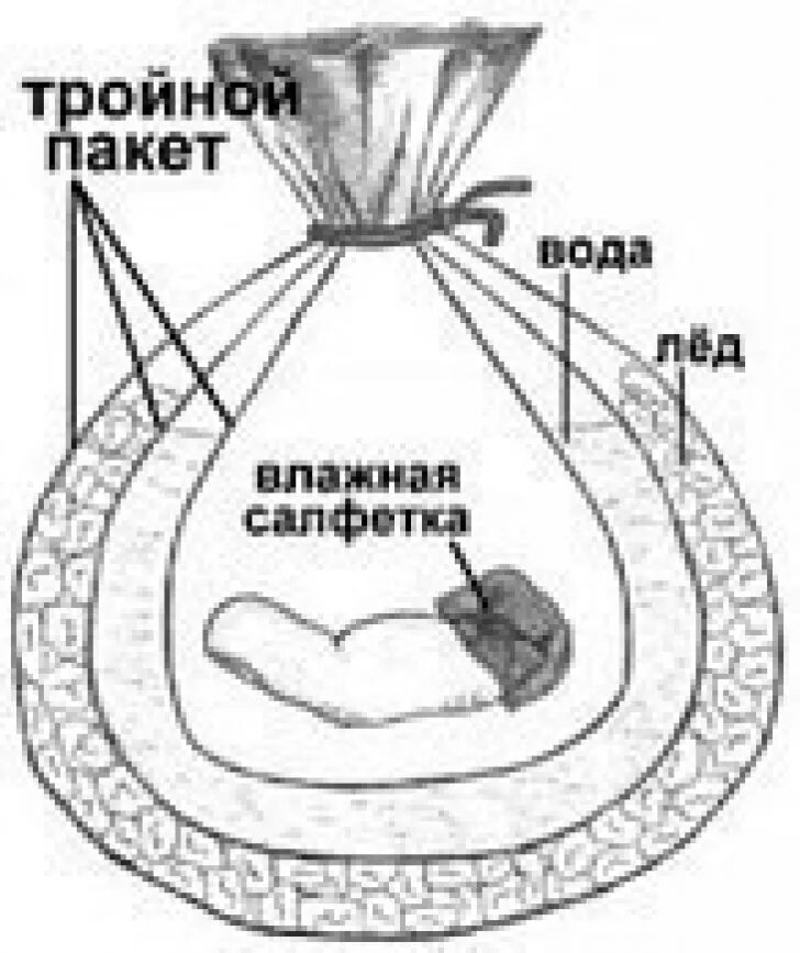 Первая помощь при травматической ампутации конечностей. Первая помощь при травматической ампутации пальцев. Травматическая ампутация запястья. Сохранение ампутированной конечности. Действия при травматической ампутации