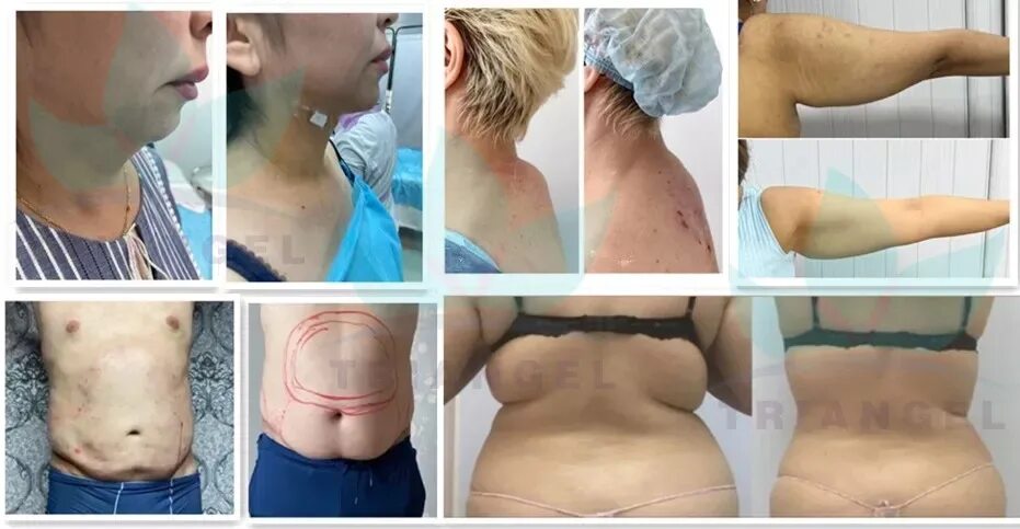 Thread Lift: Complications, Before and After, Recovery, and Cost Facial, Rostros
