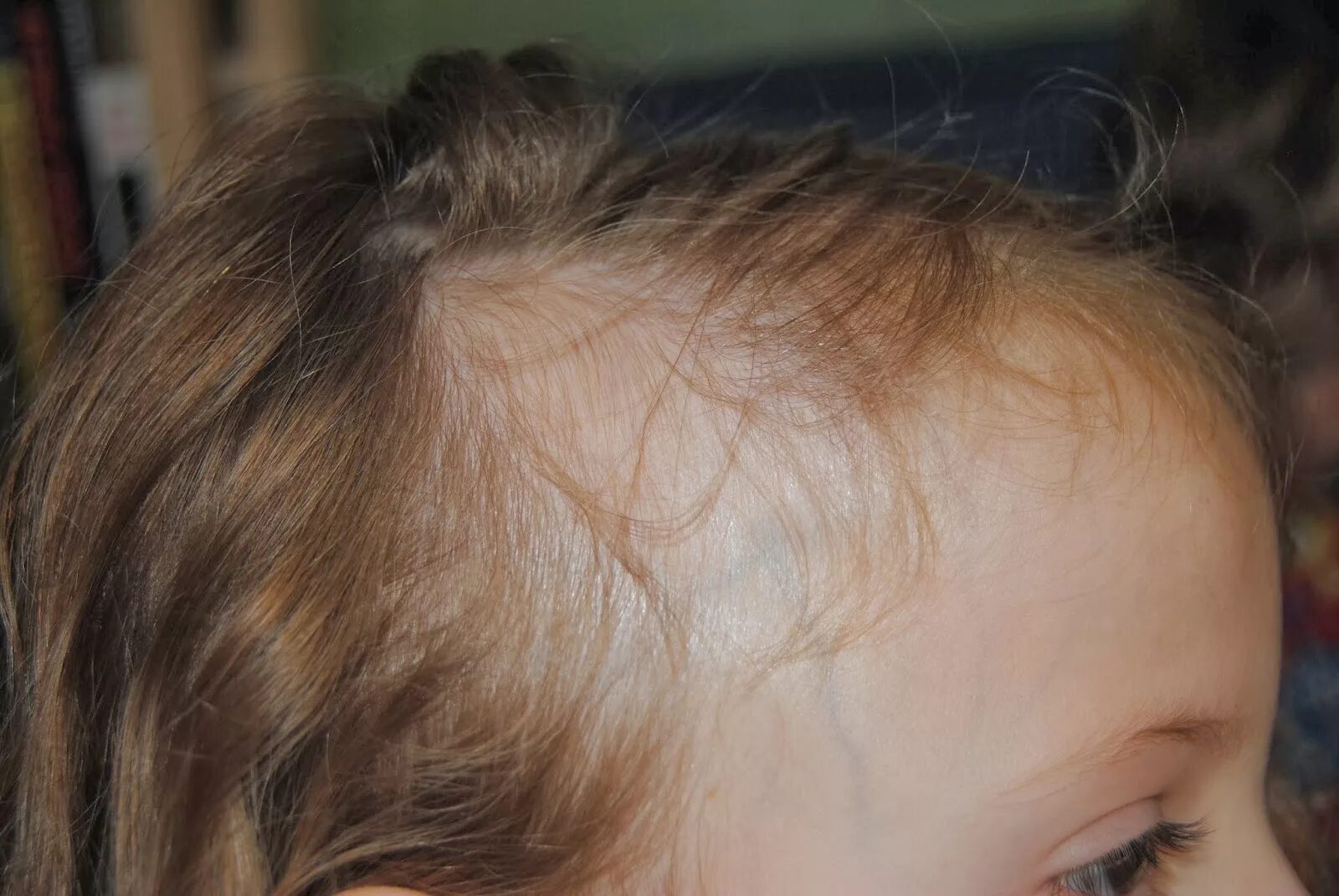 Залысина на голове у ребенка. Редкие волосы у ребенка. Почему плохо растут волосы на голове