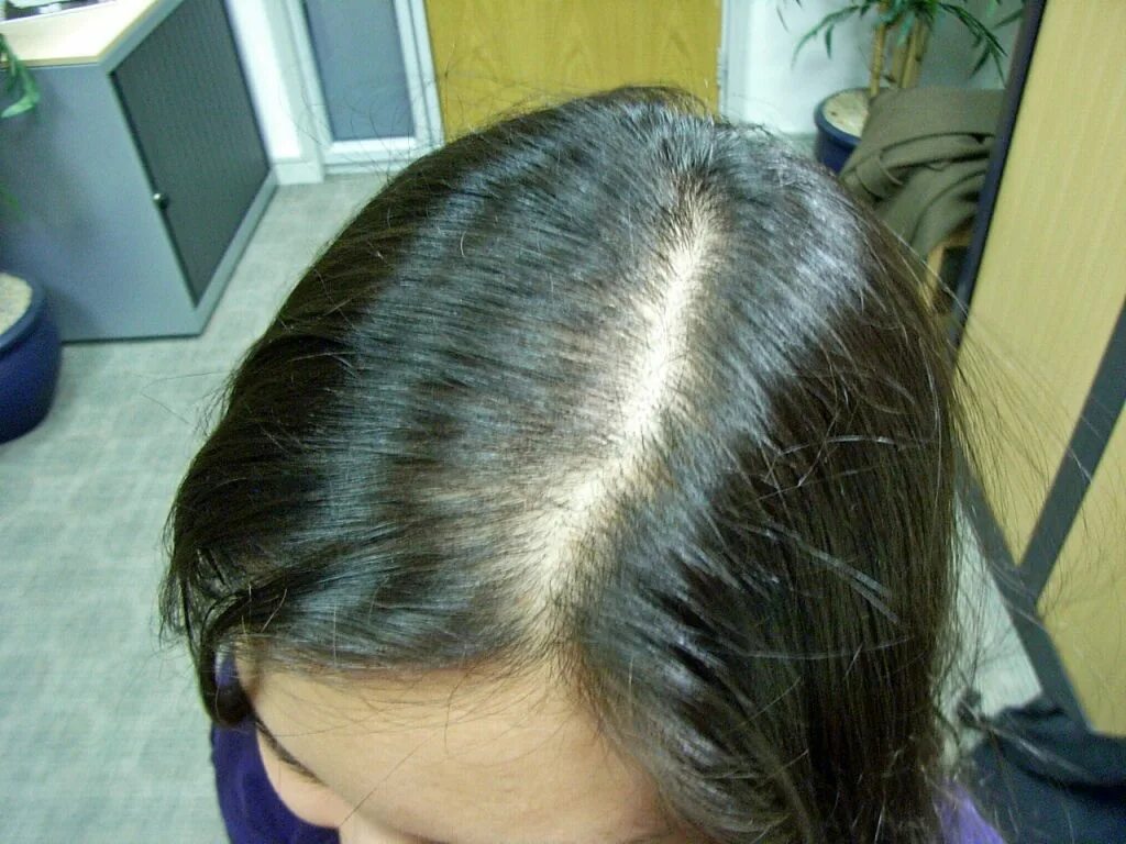 Волосы выпадают после лечения. Андрогенная алопеция алопеция. Редеют волосы.