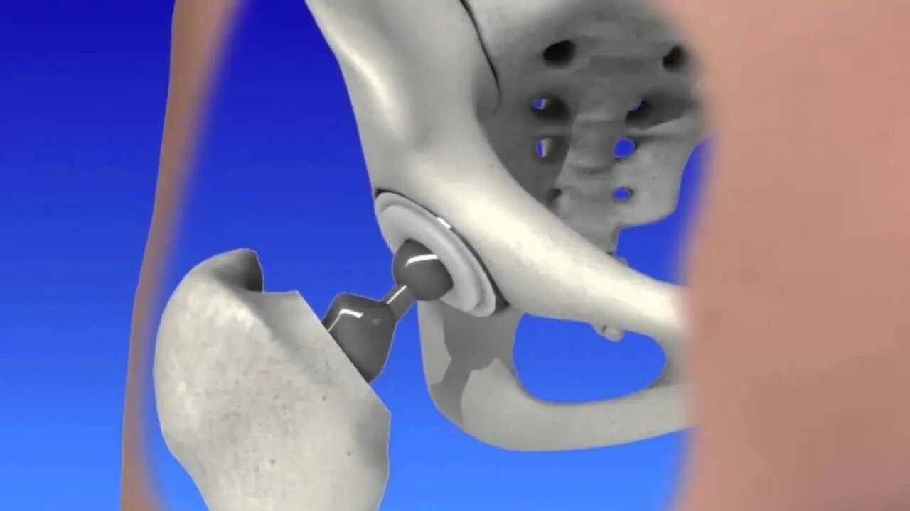 Алмаг 01 эндопротез тазобедренного сустава. Коксартроз тазобедренного сустава операция. Коксартроз эндопротезирование тазобедренного сустава. Тазобедренный эндопротез Stryker. Как делают операцию на тазобедренном