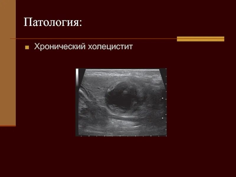 Холецистит патология. Холецистит презентация. Остром и хроническом холецистите. Воспалительные заболевания желчного пузыря. Хронический холецистит.
