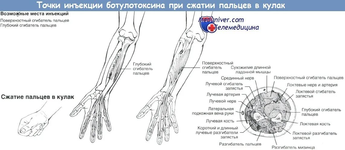 Боли при сжимании пальцев рук в кулак. Схема мышц отвечающих за сжимание пальцев в кулак. Боль при сжимании пальцев в кулак причины. Ботулинотерапия сгибатели. Точка уколова