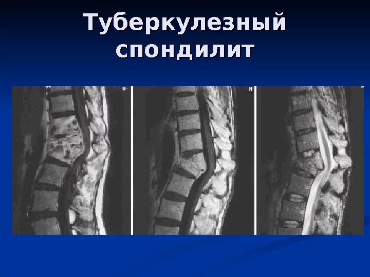 туберкулезный спондилит позвоночника. туберкулезный спондилит позвоночника рентген. туберкулез спондилит позвоночника. спондилит l1-l2 позвонков. спондилит позвоночника.