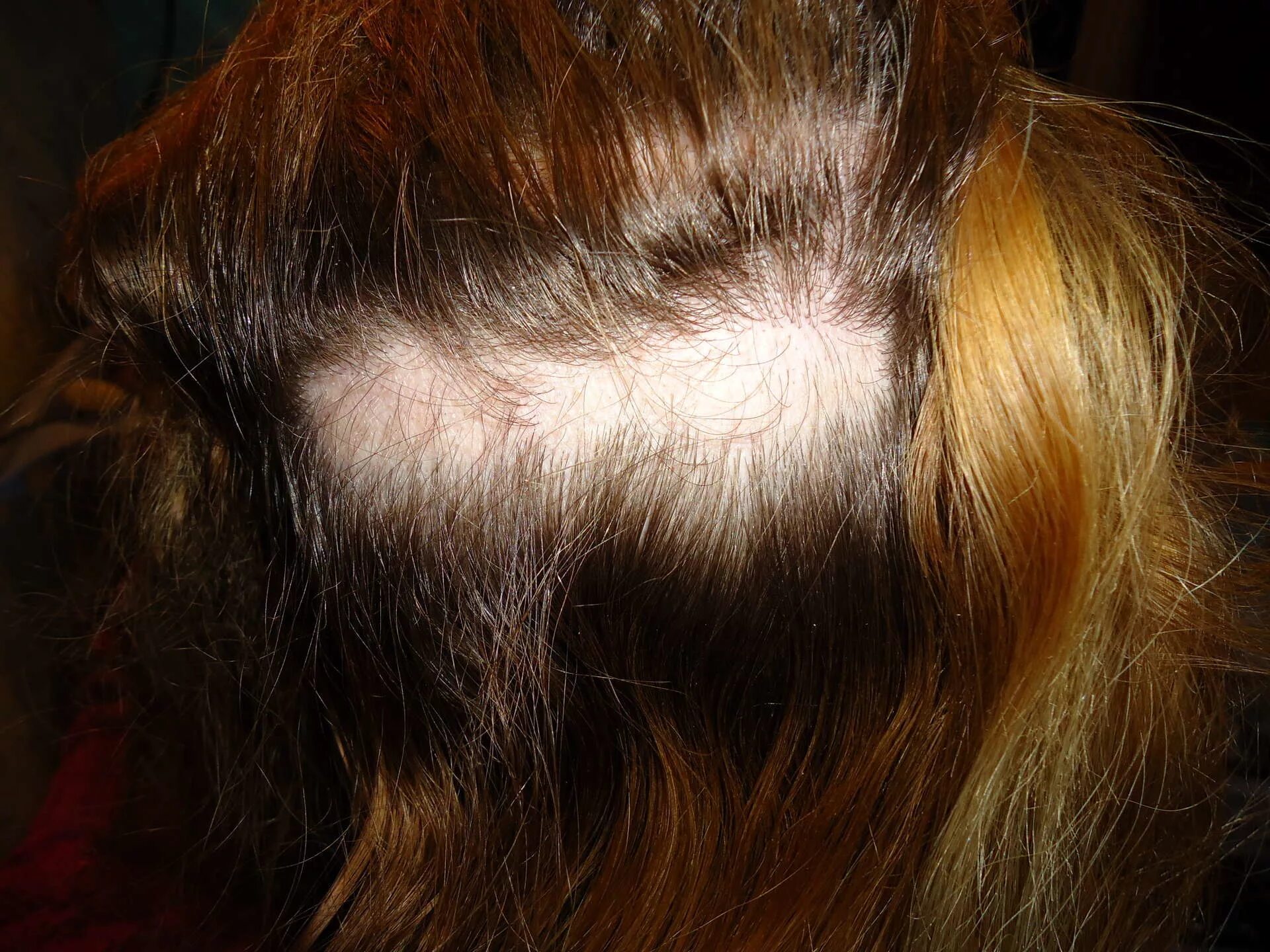 Волосы после наращивания. Последствия наращивания волос. После нарощенных волос. Нарощенные волосы последствия. Выпадают волосы после покраски