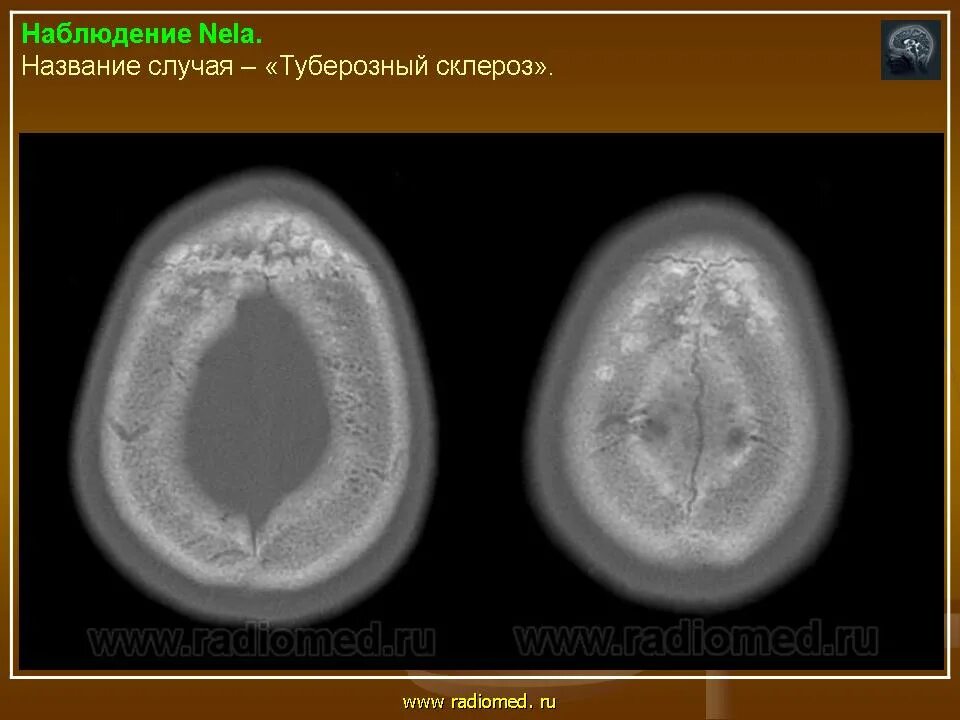 Туберозный склероз (болезнь бурневилля). Симптомы рассеянного склероза. Рассеянный склероз на снимках мрт. Рассеянный склероз картинки. Ранние стадии рассеянного склероза.