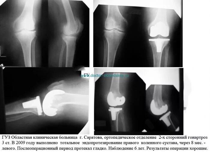 Сайт центра эндопротезирования чебоксары. Эндопротезирование коленного Stryker. Модульный эндопротез коленного сустава. Протокол операции эндопротезирования коленного сустава. Тибиальный компонент эндопротеза коленного сустава.