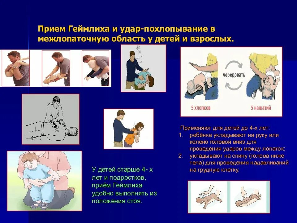 Метод геймлиха применяется при. Прием геймлиха. метод геймлиха. приём геймлиха техника выполнения у детей. приём хаймлиха геймлиха.