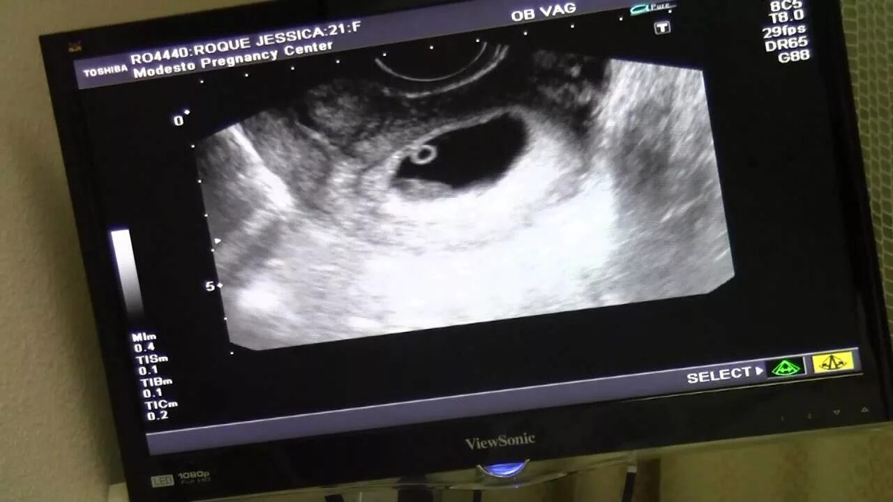 I think my sister's ultrasound deserves to be here. Ultrasound pictures, Ultraso