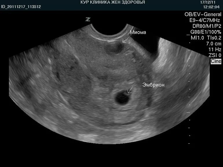Эндометрий 1 мм. Интрамуральная миома матки УЗИ. Миома матки на УЗИ 7 недель.