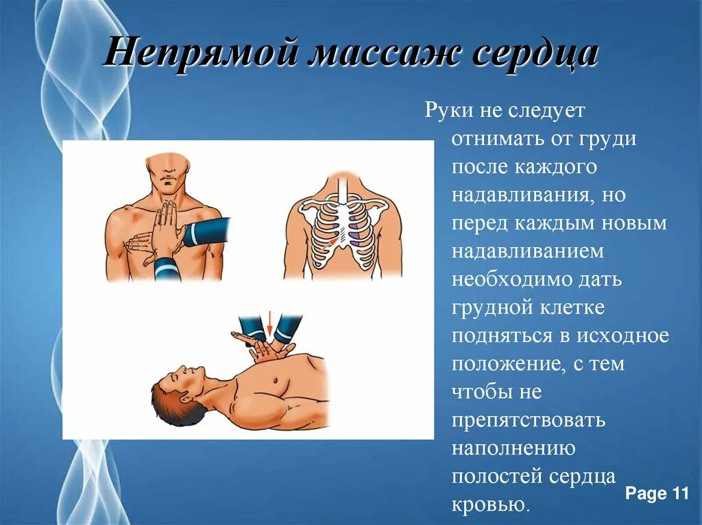 Частота надавливания при непрямом массаже. Не прямойпрямой массаж сердца. Не прямоц мпааж сердца. Непрямой массаж сердца техника. Непрямой массаж сердца метод.