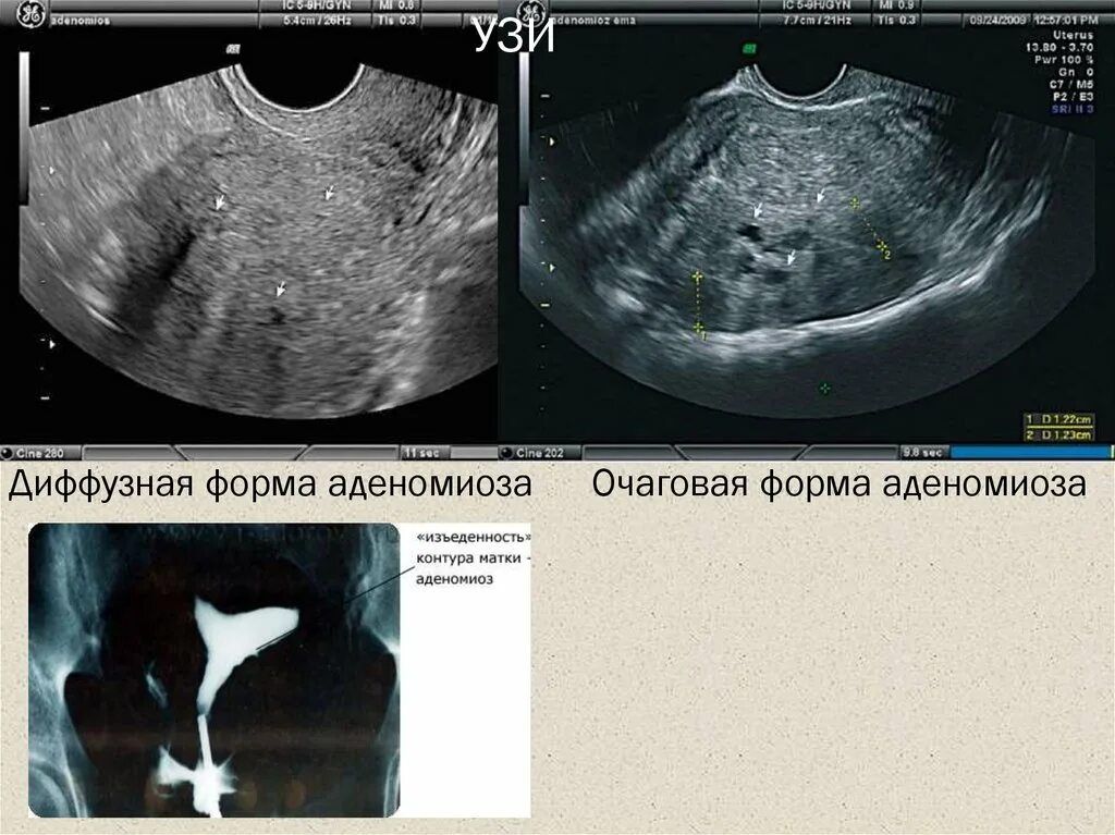 Эндометриоз очаговая форма. Очаговая форма аденомиоза.