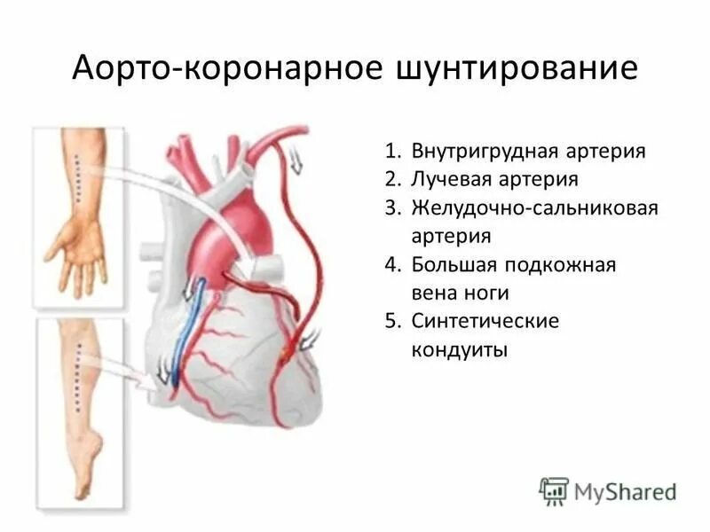 Схема операции аортокоронарного шунтирования. Аортокоронарное шунтирование с искусственным кровообращением. Шунтирование артериального сосуда. Аортокоронарное шунтирование 3 шунта. Операция коронарных сосудов