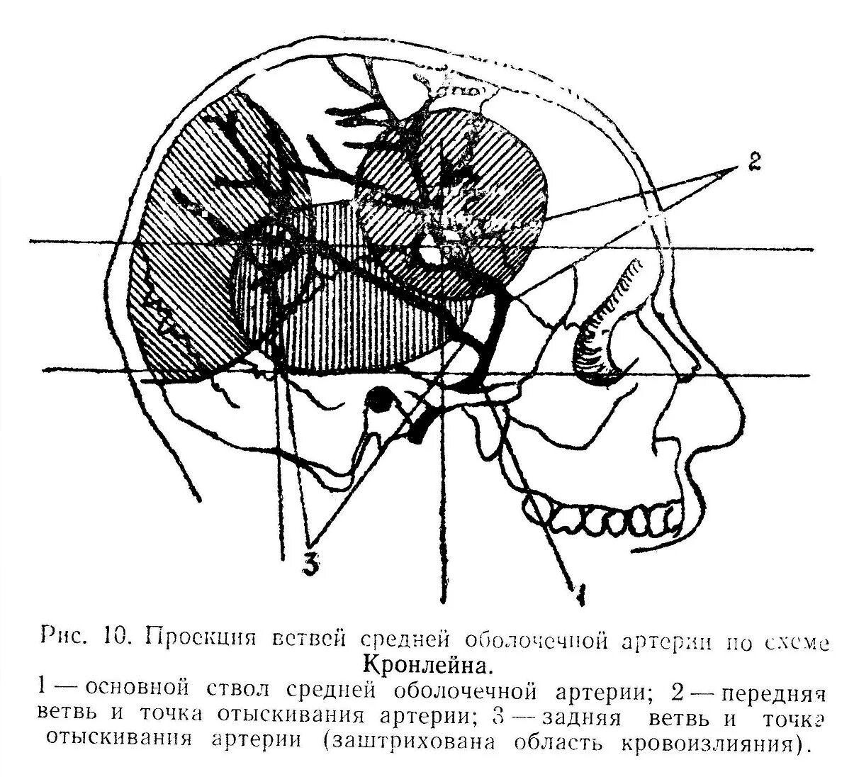 Проекция средней менингеальной артерии по схеме кренлейна. Кренлейна Брюсовой проекция средней менингеальной артерии. Затылочная эмиссарная Вена. Схема кронлейна-Брюсовой.