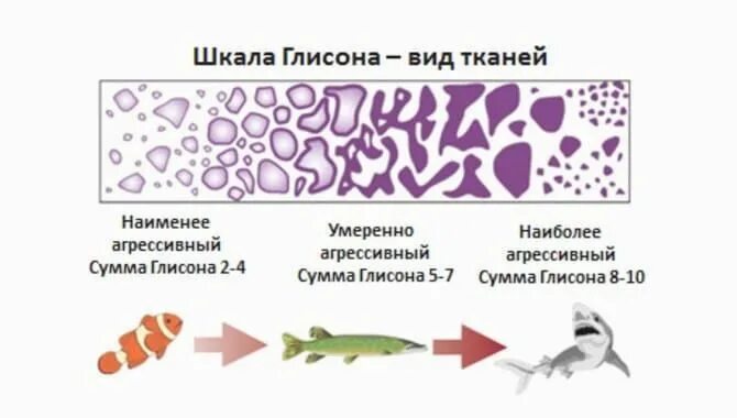 Глисон простата. Гистологическая градация Глисон. Шкала Глисона. Классификация РПЖ шкала Глисона. Сумма по глисону.