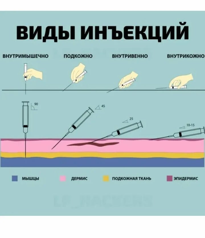 Угол иглы при внутрикожной инъекции